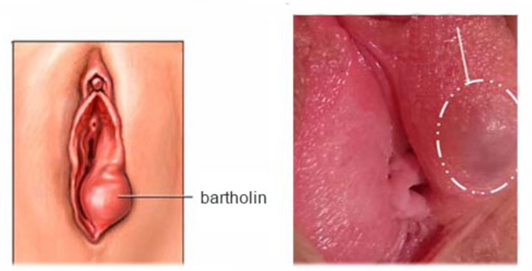U nang Bartholin là gì và có nguy hiểm?