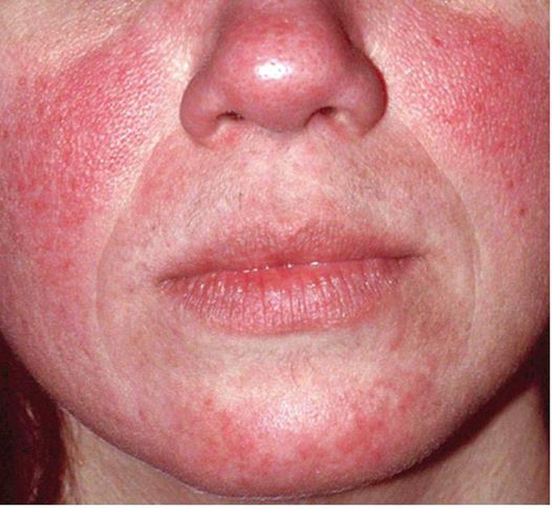 Tìm hiểu bệnh viêm da do Demodex