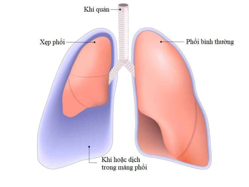 Kỹ thuật đốt khối u phổi bằng sóng cao tần