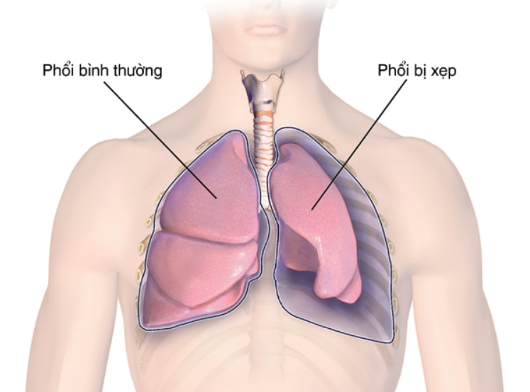 Nguyên nhân và triệu chứng xẹp phổi