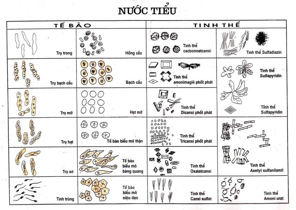 Xét Nghiệm Soi Cặn Nước Tiểu Bằng Phương Pháp Thủ Công