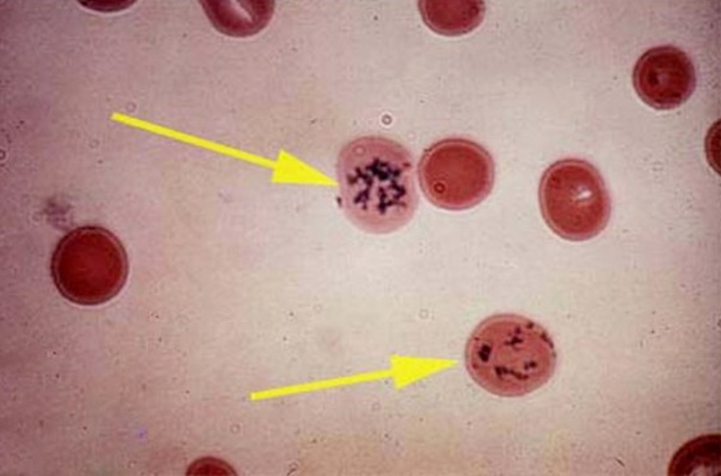 Thông tin cần biết về xét nghiệm hồng cầu lưới