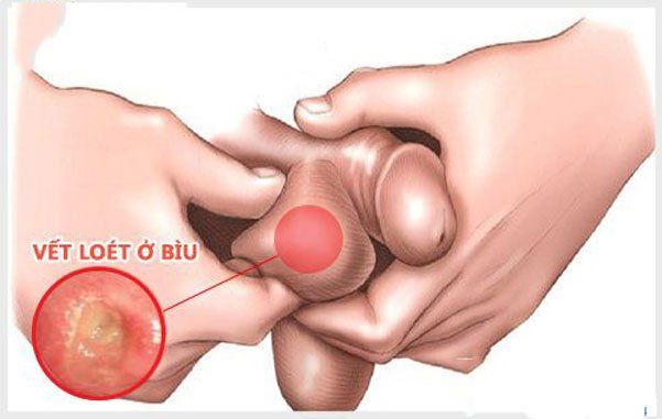Bệnh Behcet: Chẩn đoán và điều trị