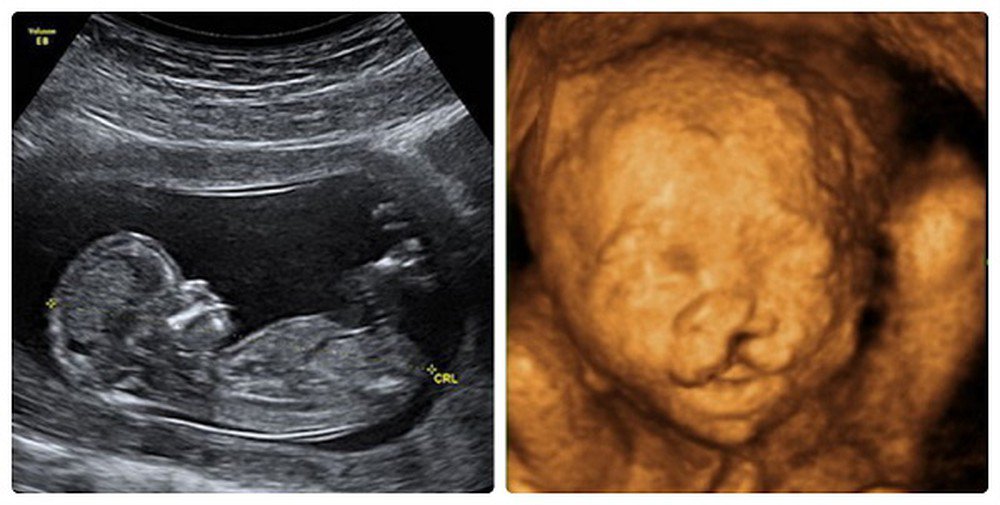 Cùng khám phá những hình ảnh siêu âm dị tật thai nhi, hình ảnh này là sản phẩm của công nghệ tiên tiến giúp các bác sĩ có thể dễ dàng phát hiện và chẩn đoán các vấn đề về sức khỏe của thai nhi trước khi chào đời.