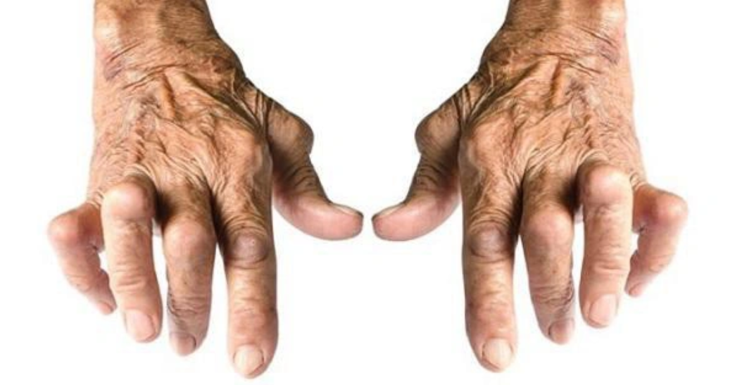 Các bệnh tự miễn thường gặp