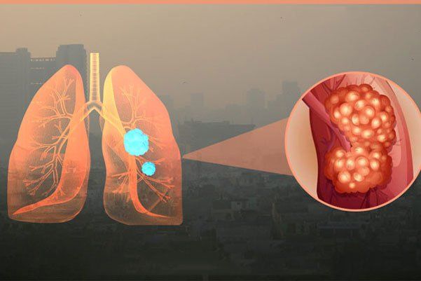 Ô nhiễm không khí và các bệnh đường hô hấp