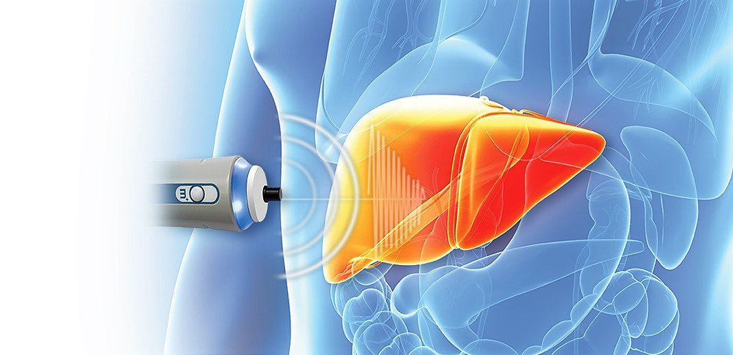 Kết quả đo độ cứng của gan sau siêu âm đàn hồi mô gan (Fibrosis)