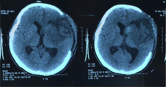 Phù não là gì? Nguyên nhân và triệu chứng