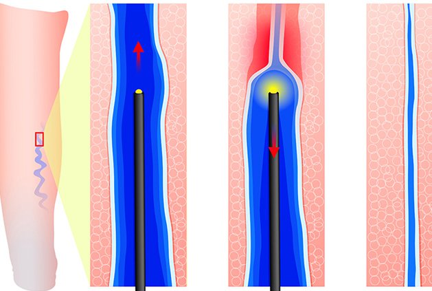 Điều trị suy giãn tĩnh mạch chi dưới bằng laser