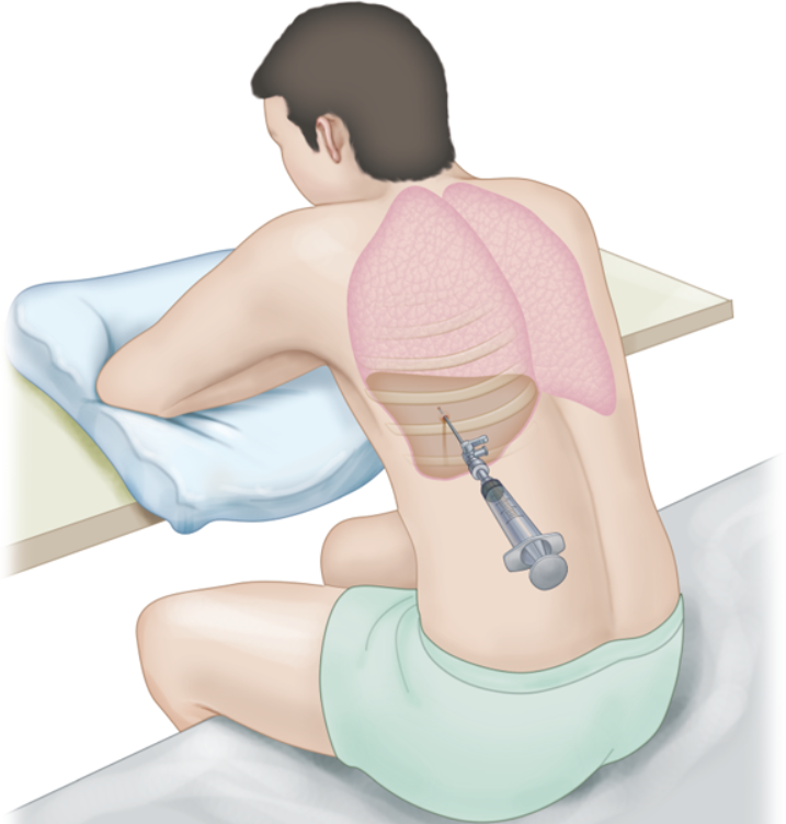 Vai trò của xét nghiệm Adenosine Deaminase