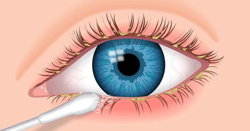 Viêm bờ mi mắt điều trị thế nào?
