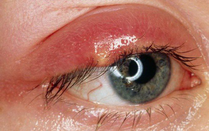 Viêm bờ mi mắt điều trị thế nào?