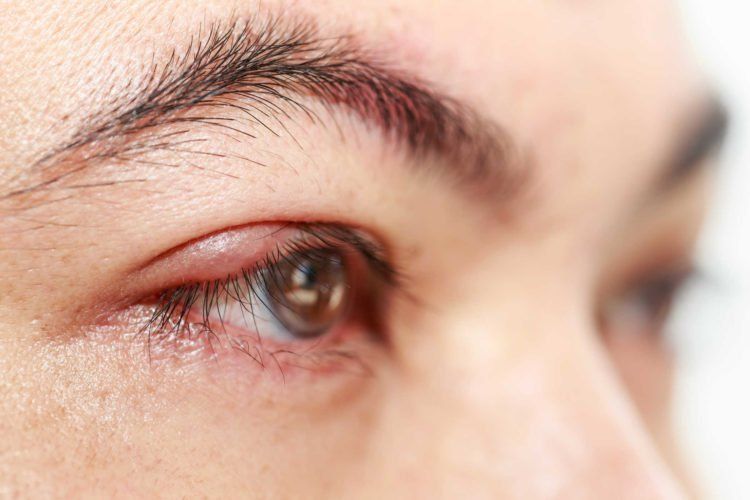 Bỏng mắt: Nguyên nhân, phân loại và đặc điểm tổn thương