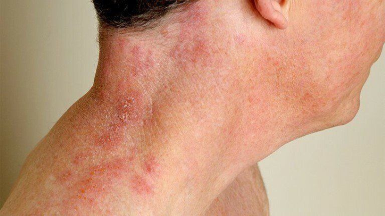 Thuốc chống kháng virus Acyclovir: Công dụng, liều dùng, tác dụng phụ