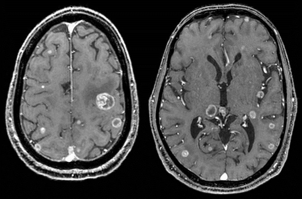 Chụp cộng hưởng từ (MRI) có ảnh hưởng gì tới cơ thể?
