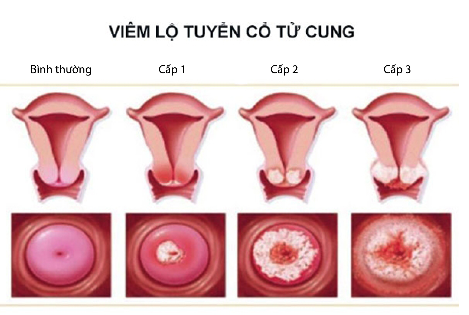 Viêm lộ tuyến cổ tử cung 1cm là nặng hay nhẹ ?