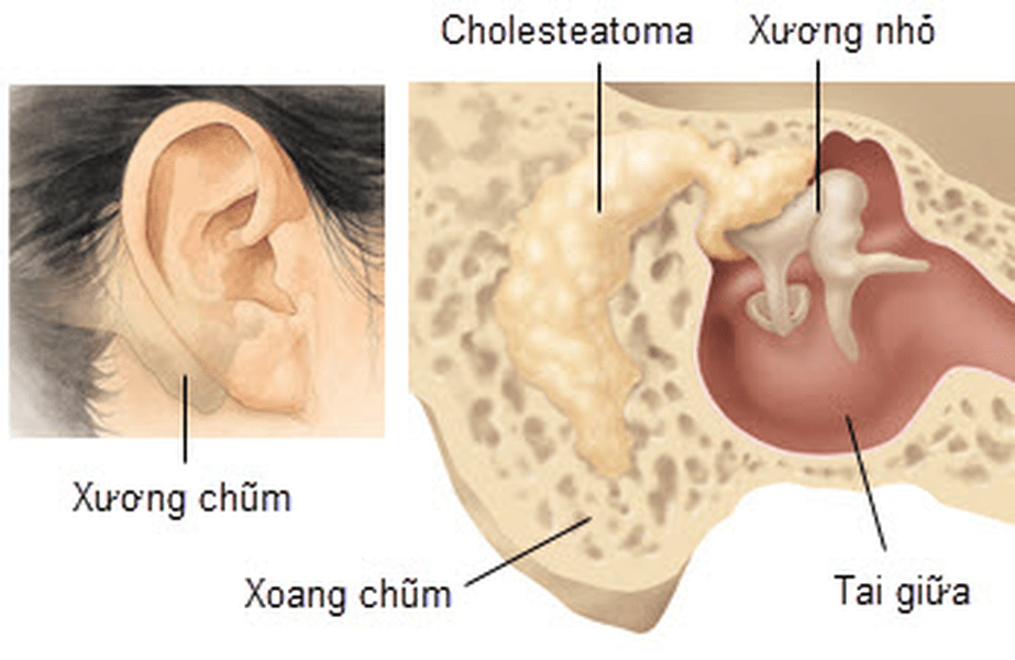 Mục đích chụp x quang xương chũm