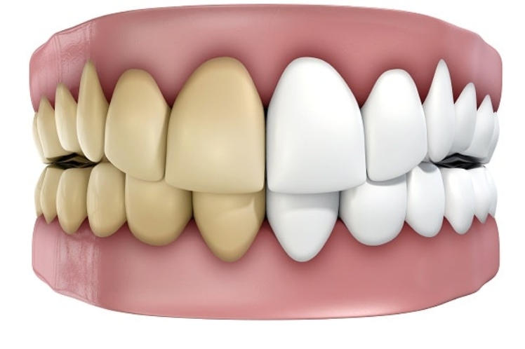 Bọc răng sứ rồi có tẩy trắng được không?