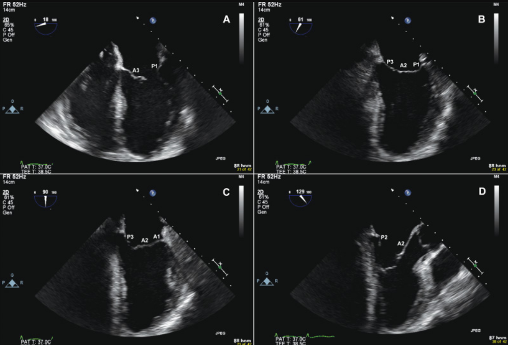 Các mặt cắt cơ bản trong siêu âm tim
