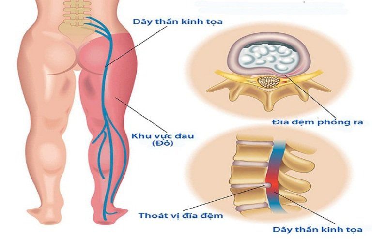 Đau thần kinh tọa là gì?