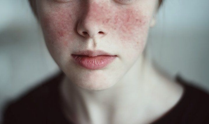 Bệnh tan máu tự miễn: Chẩn đoán, điều trị