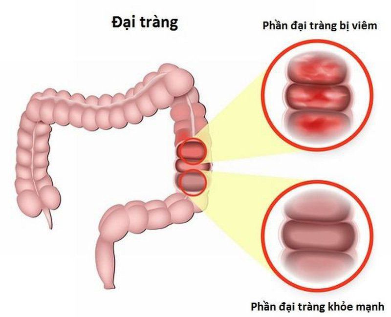 Thuốc Atezolizumab: Công dụng, chỉ định và lưu ý khi dùng