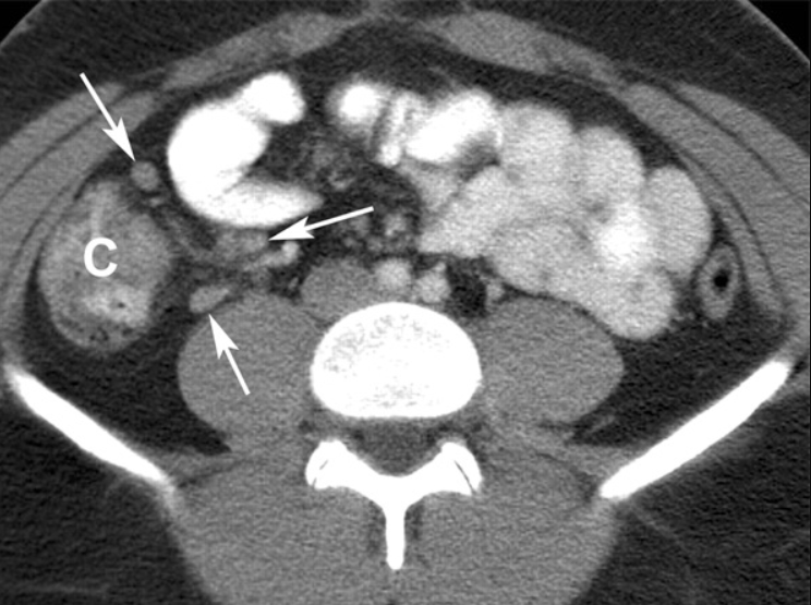 Viêm hạch mạc treo là gì?