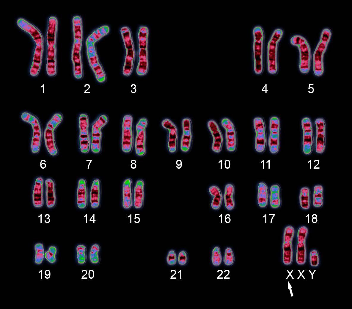 Các bệnh do bất thường nhiễm sắc thể gây ra