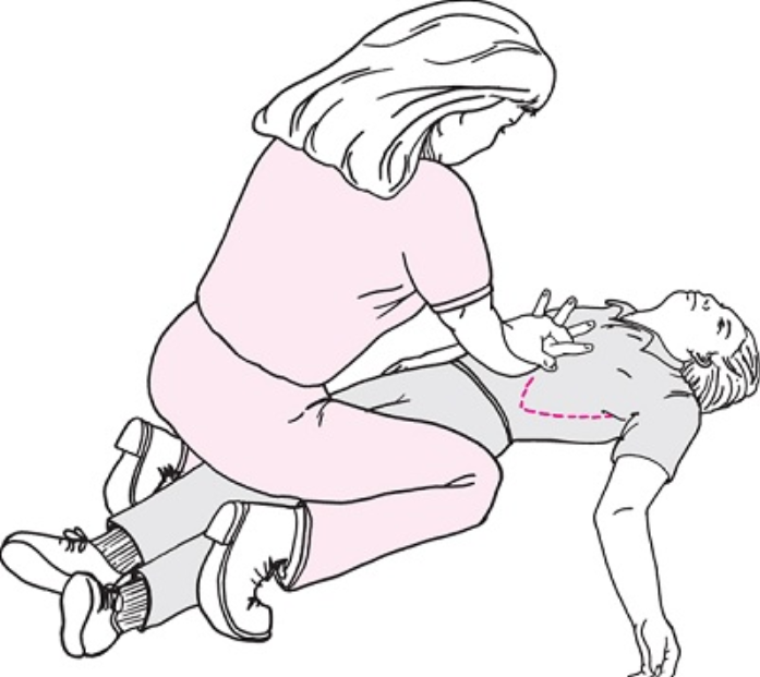 Heimlich nằm ngửa