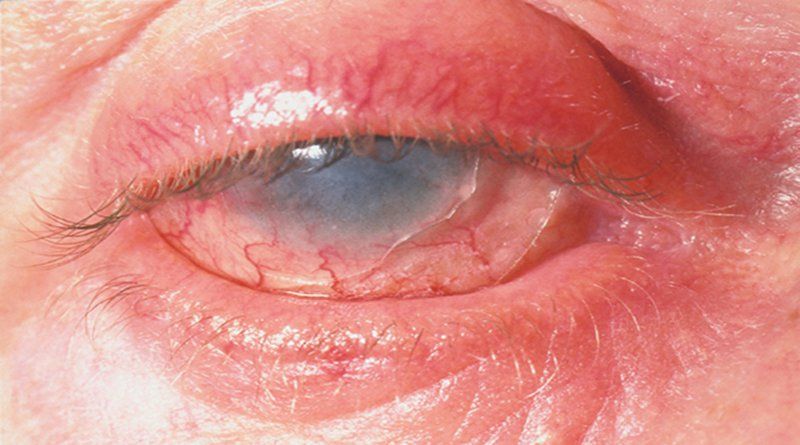 Thuốc Cefixim: Công dụng, liều dùng và tác dụng phụ