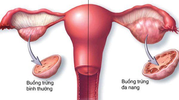 Sử dụng thuốc Duphaston ở bệnh nhân buồng trứng đa nang