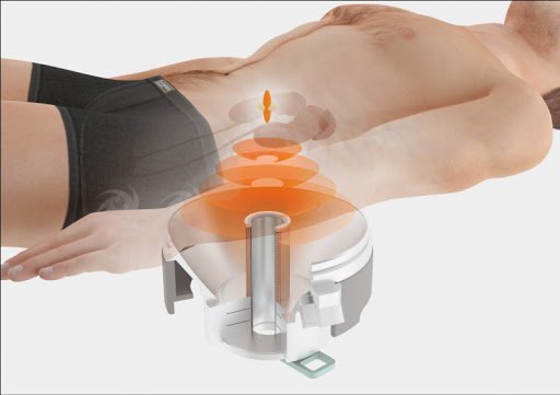 Ưu điểm của tán sỏi thận ngoài cơ thể