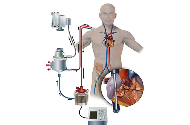 Tìm hiểu về kỹ thuật ECMO (Tim - phổi nhân tạo)