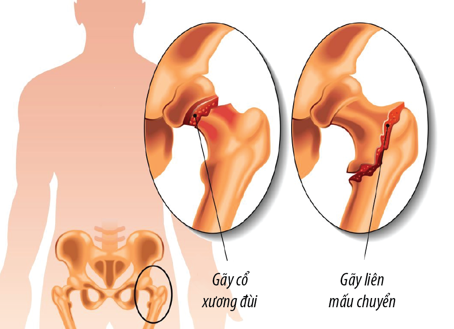 Chụp cộng hưởng từ (MRI) khớp háng