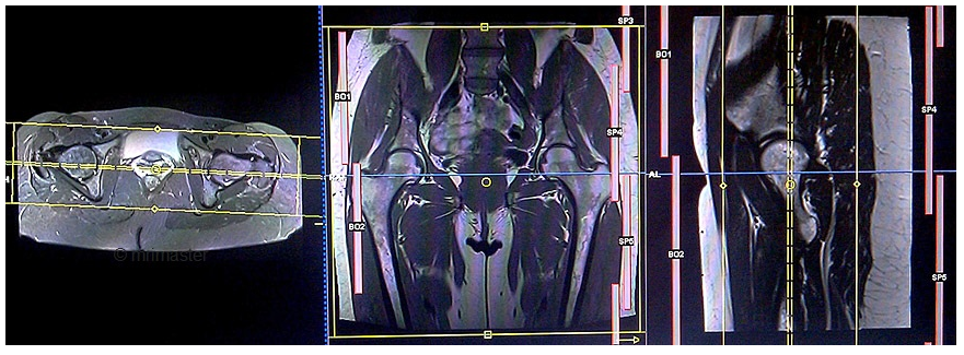 Chụp cộng hưởng từ (MRI) khớp háng