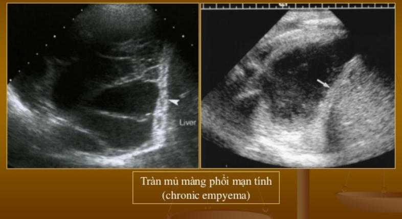 Siêu âm màng phổi cấp cứu