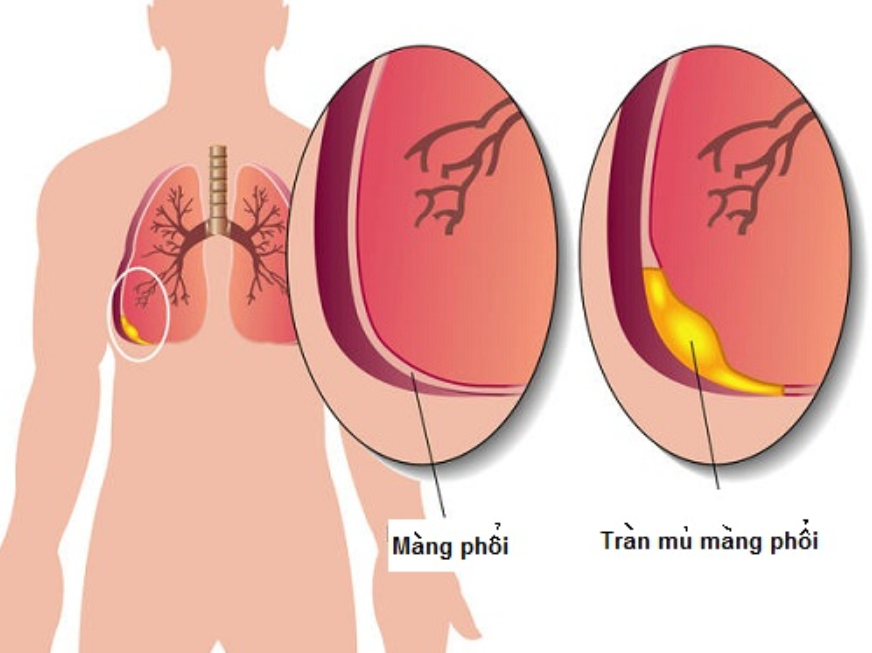 Viêm mủ màng phổi: Chẩn đoán và điều trị