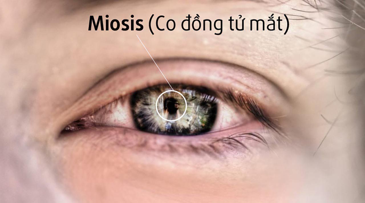 Điều trị ngộ độc ma túy nhóm Opi