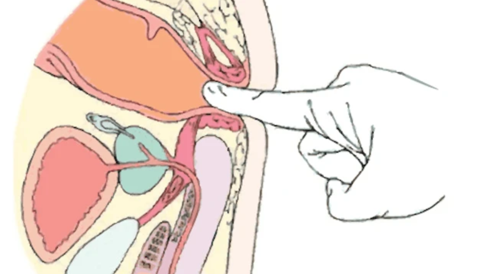 Nong hậu môn sau phẫu thuật có hẹp