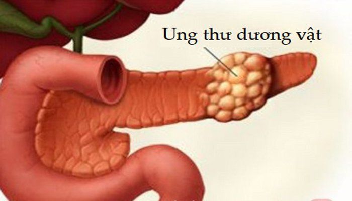 Cắt dương vật không vét hạch: Chỉ định và hiệu quả