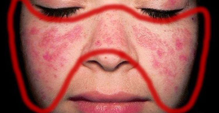 Bệnh lupus ban đỏ hệ thống là gì?