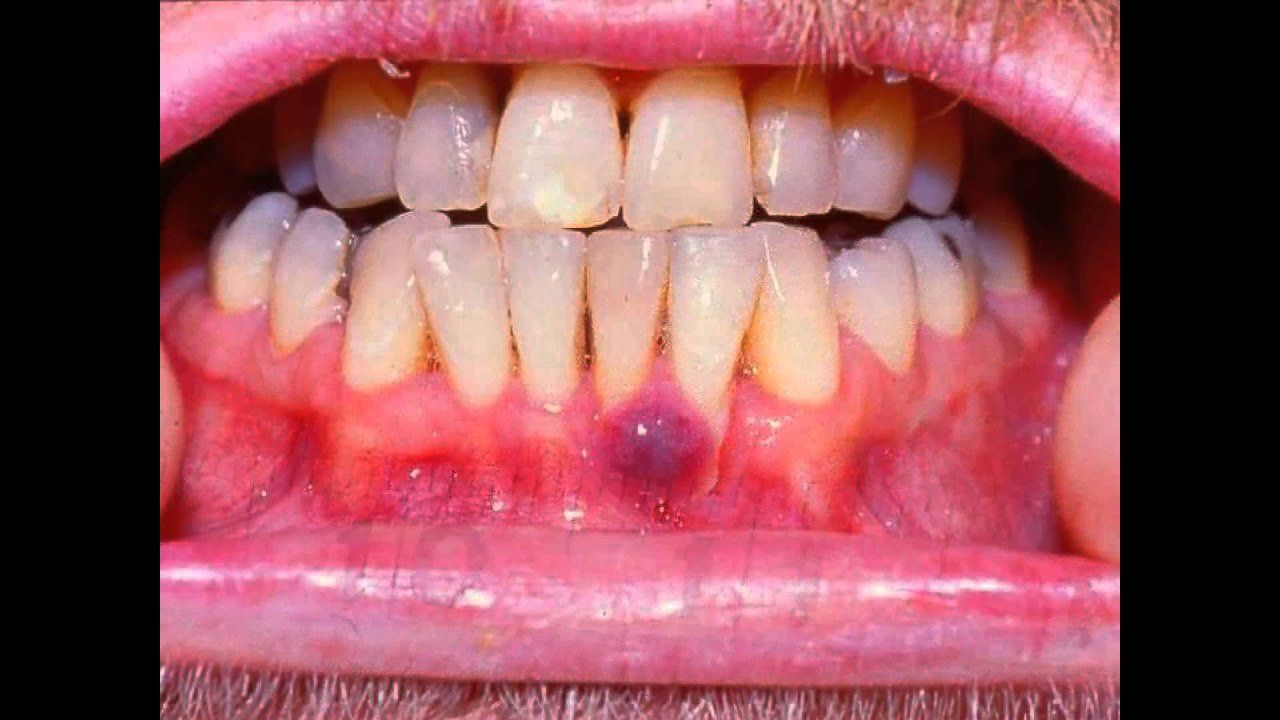 Tổng quan về Ung Thư Kaposi (Sacorma Kaposi)