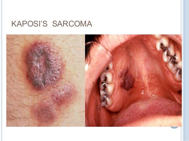 Tổng quan về Ung Thư Kaposi (Sacorma Kaposi)