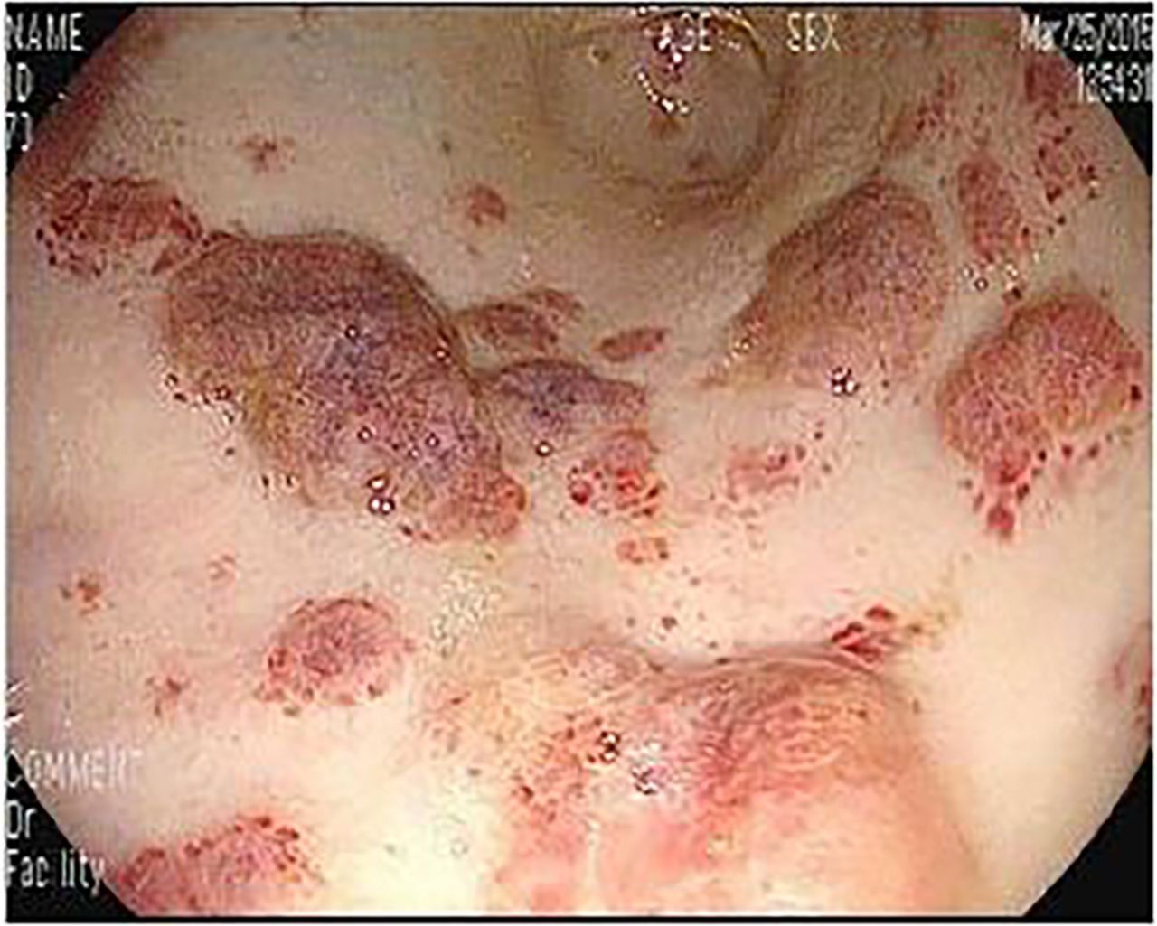 Tổng quan về Ung Thư Kaposi (Sacorma Kaposi)