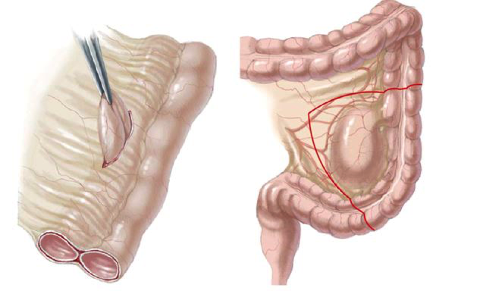 Nang ruột đôi là bệnh gì?