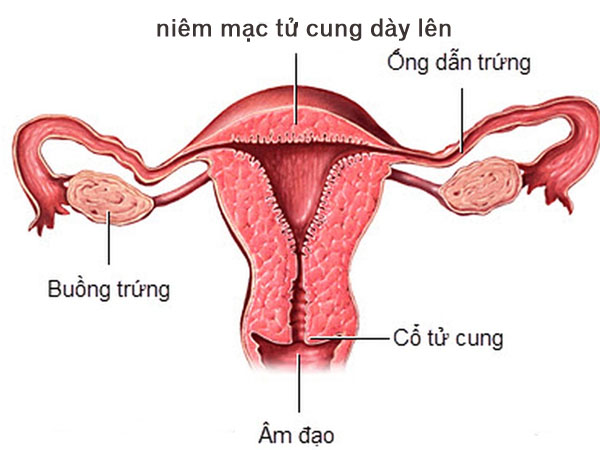 Niêm mạc tử cung quá dày ảnh hưởng thế nào tới việc thụ thai?