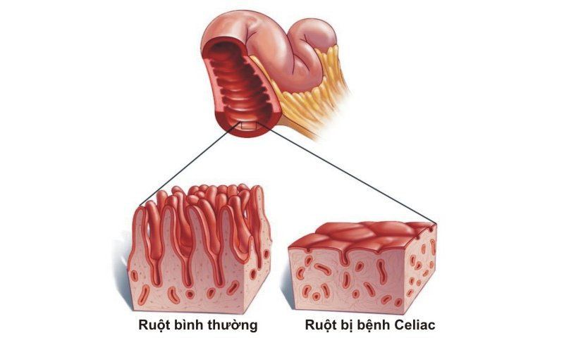 Gluten là gì và thực phẩm nào có gluten?