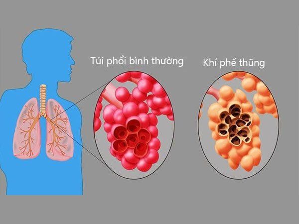 Các dị tật bẩm sinh của phối, khí quản, phế quản