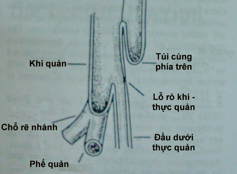 Các dị tật bẩm sinh của phối, khí quản, phế quản