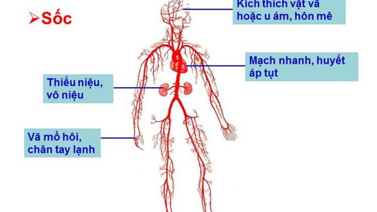 Xử trí cấp cứu do sốc giảm thể tích máu
